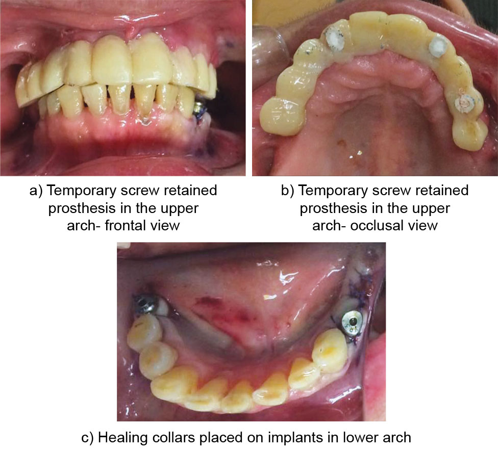 Immediate Placement and Loading of Full Arch Dental Implants in An