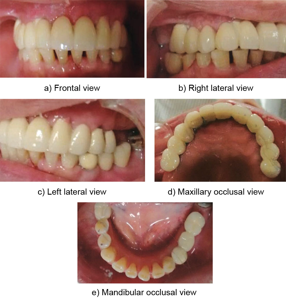 Immediate Placement and Loading of Full Arch Dental Implants in An
